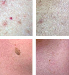 cryopen estetiska kliniken pigmenteringar åldersfläckar fibrom